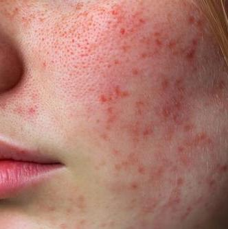 Pigment & Tone Correction