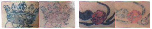 PicoKing EL950 Tattoo Removal Before After 1