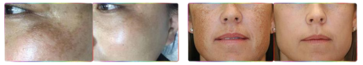 PicoKing EL950 Skin Rejuvenation Before After 3